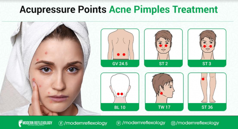 Treating Acne