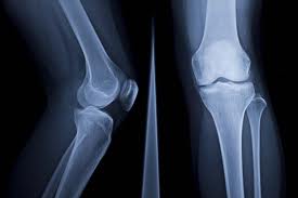 knee joint pain