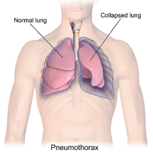 Acupressure Points to Treat Lung Diseases