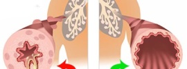 Lung Disease Caused by Affected Airways