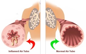 Lung Disease Caused by Affected Airways