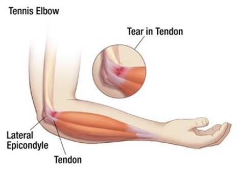 Symptoms of Tennis Elbow