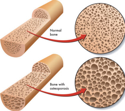 osteoporosis