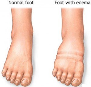 Edema