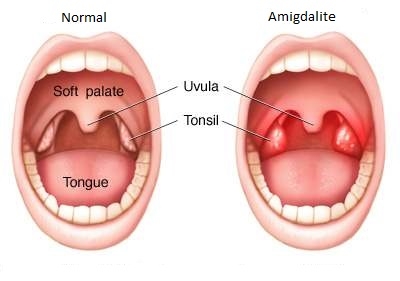 Tonsillitis, a Recurring Problem