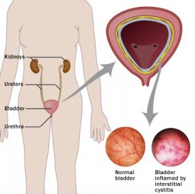 Pelvic Tension Symptoms Recommendations And Relaxation Techniques