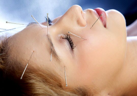 acupuncture-treatment