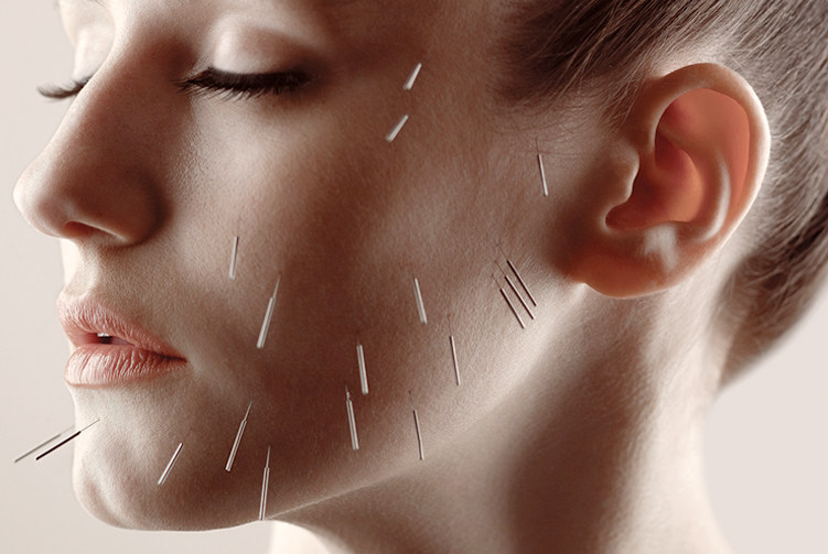 acupuncture for acne