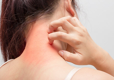 acupuncture points for eczema