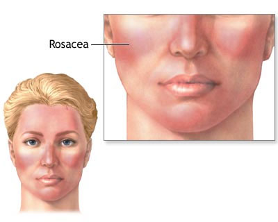 acupuncture-treats-rosacea-1