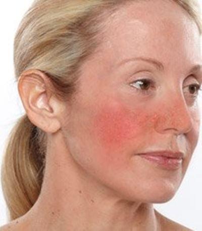 acupuncture-treats-rosacea