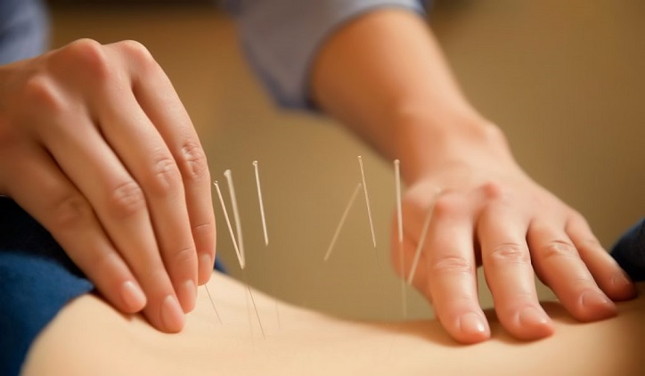 acupuncture-procedure