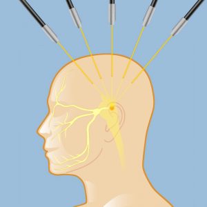 radiation-for-trigeminal-neuralgia-lg