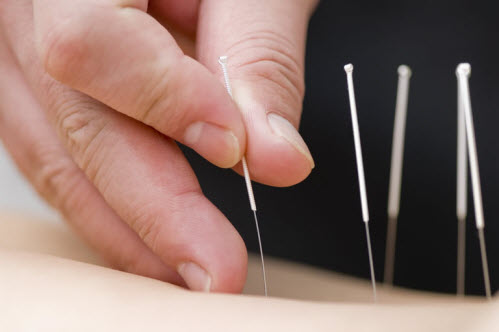 tcm-acupuncture