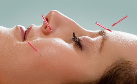 acupuncture-for-insomnia