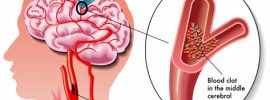 vascular-dementia-symptoms
