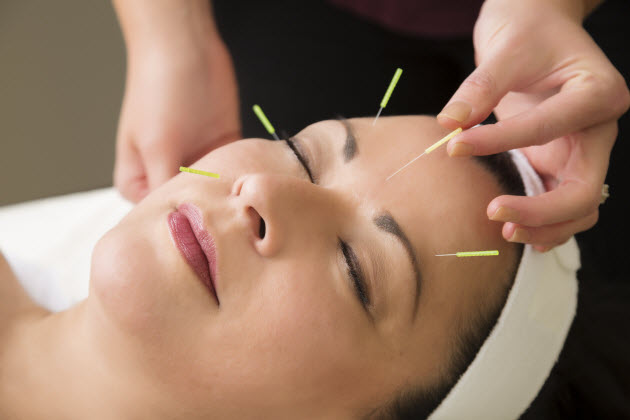 acupuncture-to-avoid-the-onset