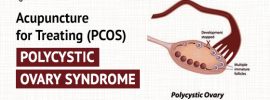 Acupunctue treatment for Polycystic Ovary Syndrome