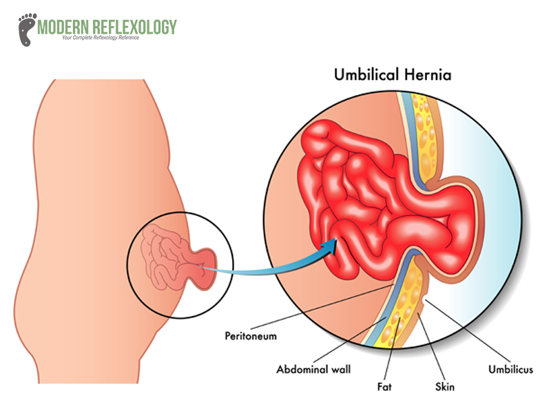 Umbilical Hernia