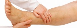 vericose vein -treating through acupressure