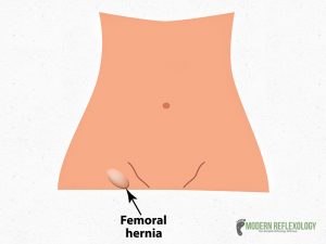 Femoral