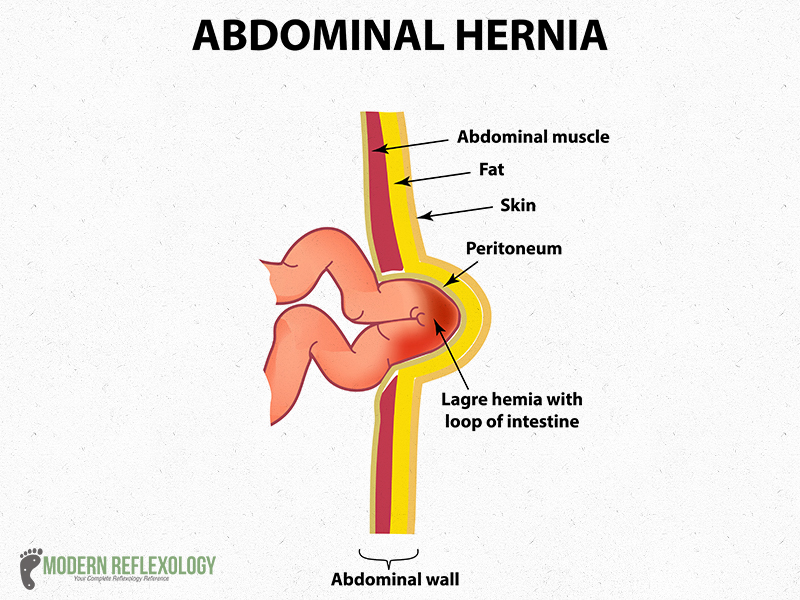 Best 3 Acupressure Points For Treating Different Types Of Hernia