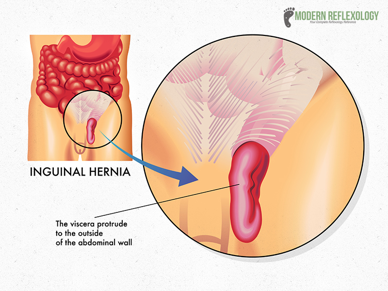 Inguinal-Hernia