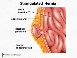 Strangulated-Hernia