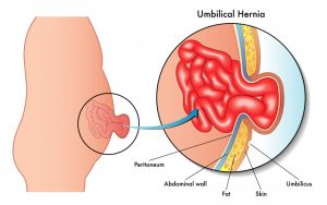 umbilical-hernia-