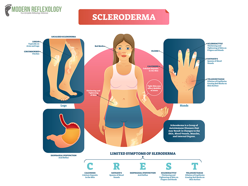 Scleroderma Crest Symptoms