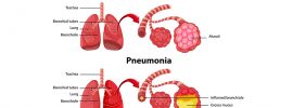 What is Pneumonia