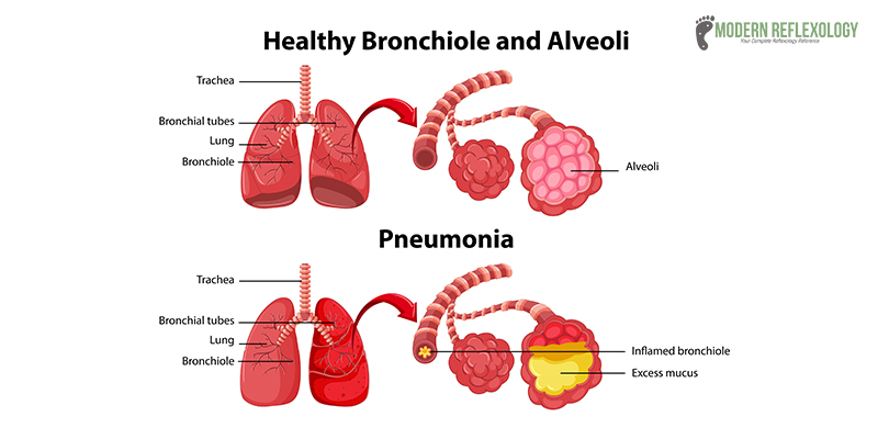 What is Pneumonia